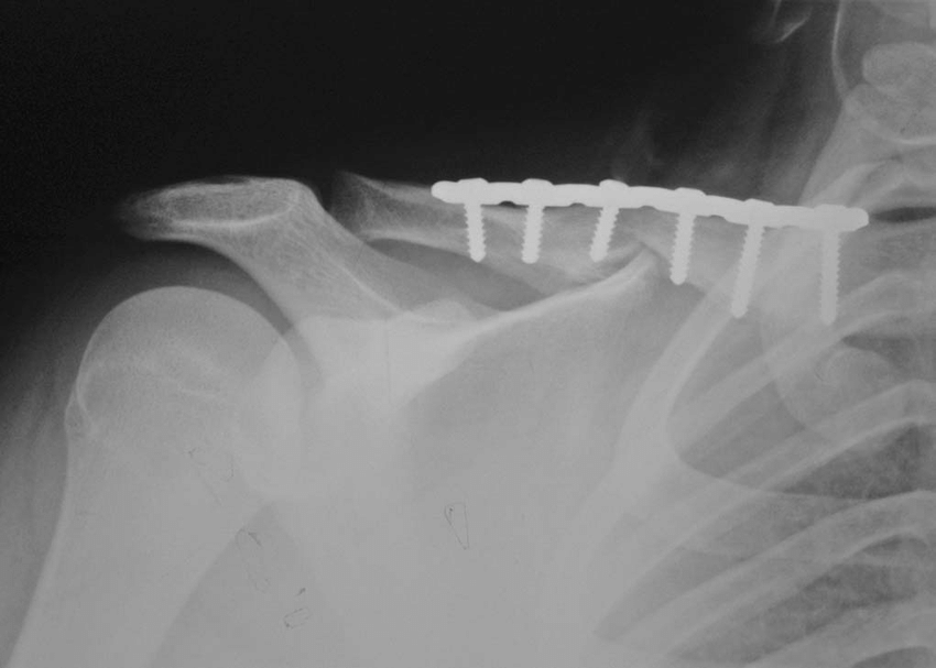Clavicle Fixation Study